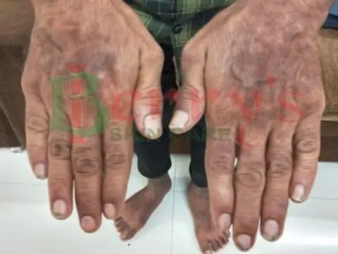 After Psoriasis treatment result