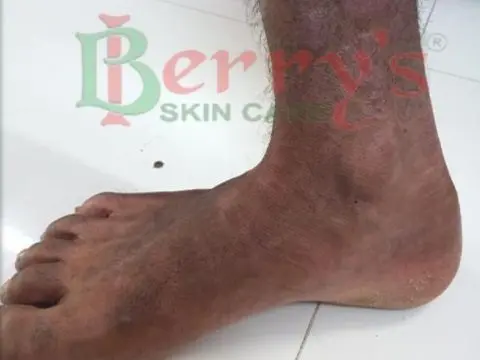 Before Psoriasis treatment result