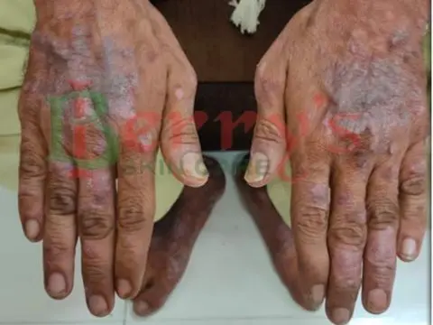 Before Psoriasis treatment result