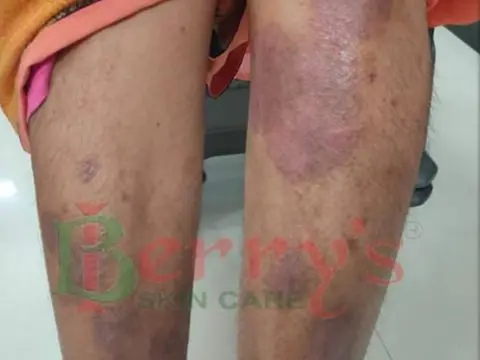 After Vitiligo treatment result