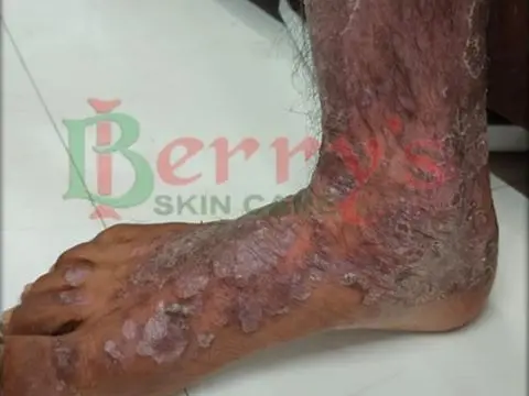 Before Psoriasis treatment result