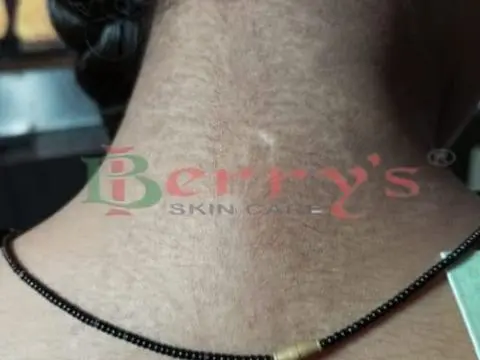 After Vitiligo treatment result