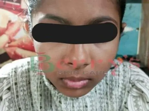 After Vitiligo treatment result