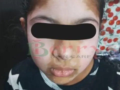 After Vitiligo treatment result